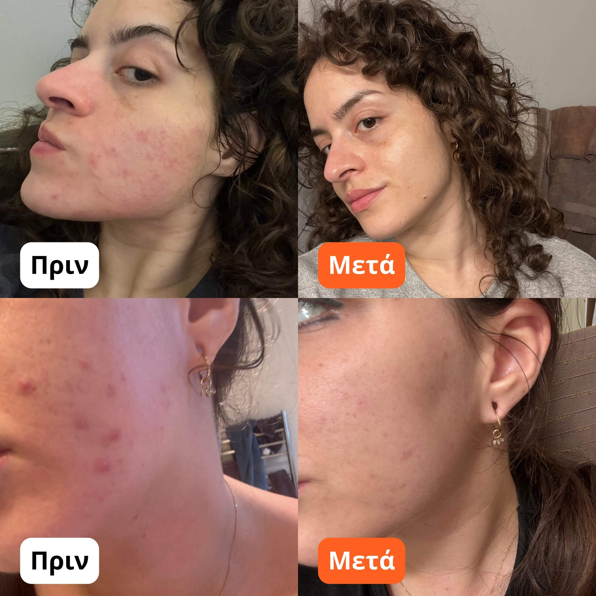 Κρέμα για Ακμή & Ερυθρότητα