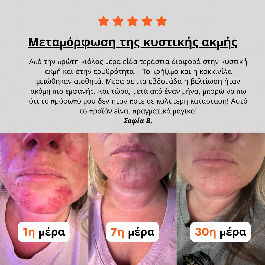Κρέμα για Ακμή & Ερυθρότητα