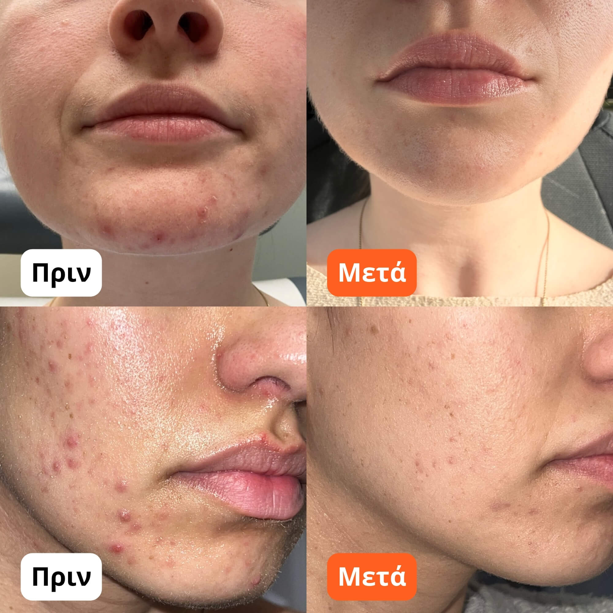 Κρέμα για Ακμή & Ερυθρότητα