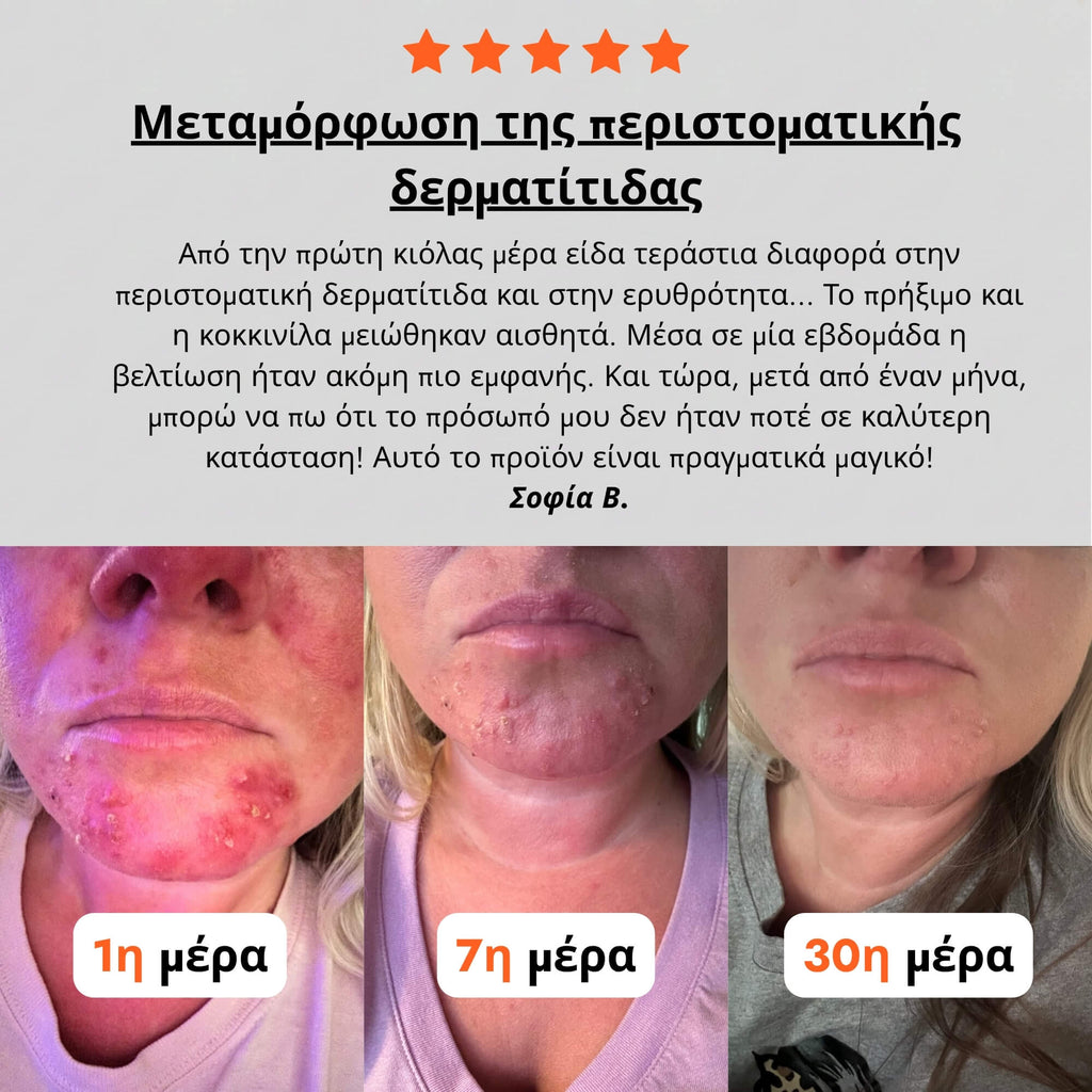 Κρέμα για Περιστοματική Δερματίτιδα & Ακμή