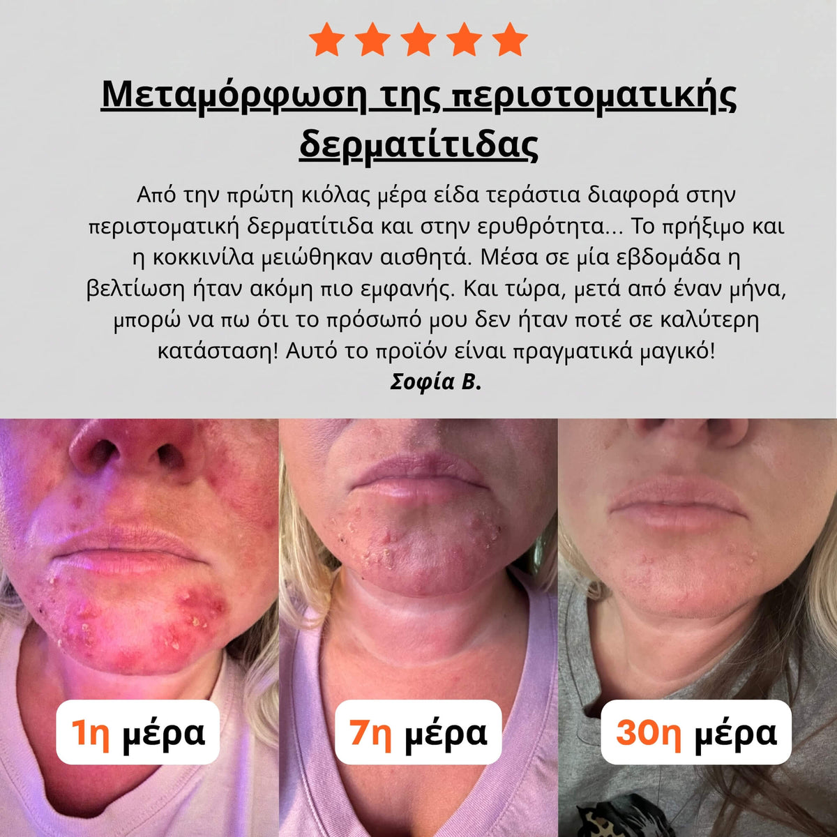 Κρέμα για Περιστοματική Δερματίτιδα & Ακμή